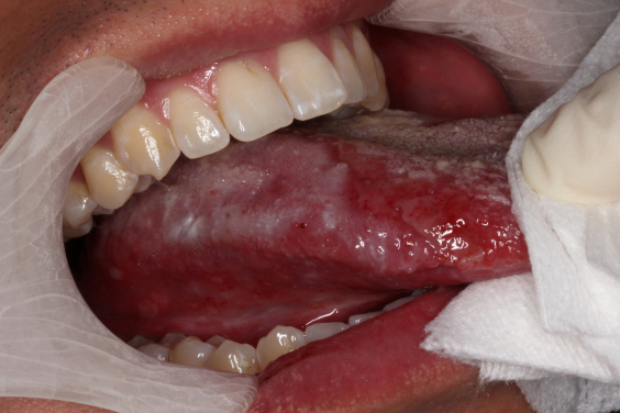 Patient suffering from tongue lichenoid mucositis